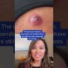 Dr Pimple Popper Reacts to Inflamed Cyst! #shorts #drpimplepopper