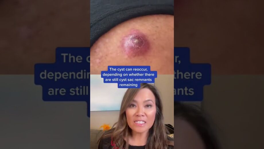 Dr Pimple Popper Reacts to Inflamed Cyst! #shorts #drpimplepopper